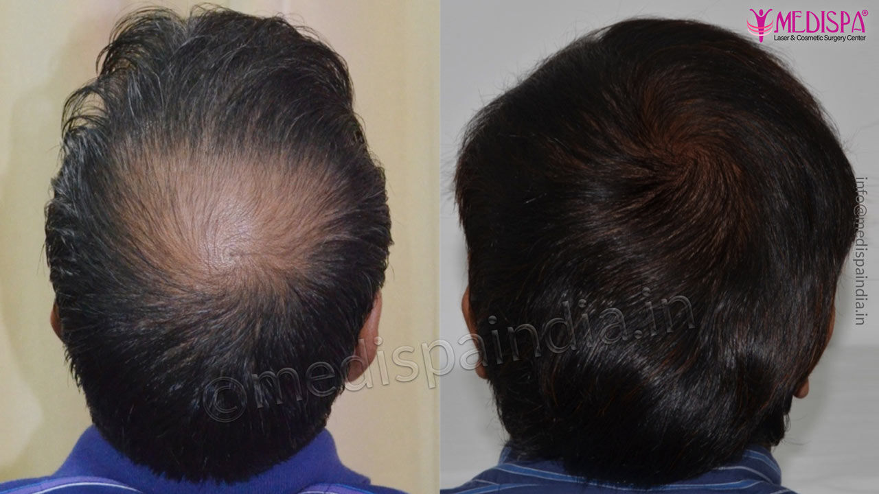 hair transplant cost