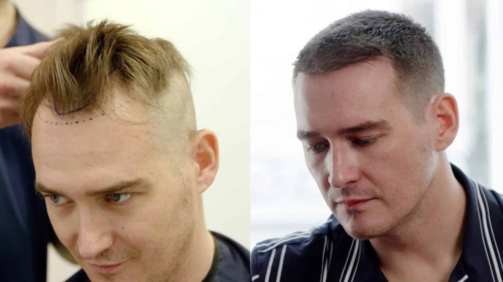 Hair transplant birmingham