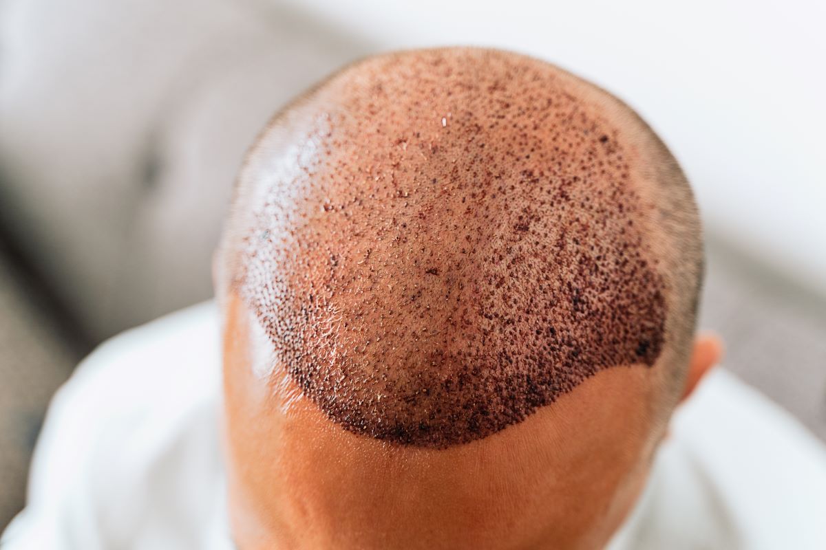 Hair transplant birmingham