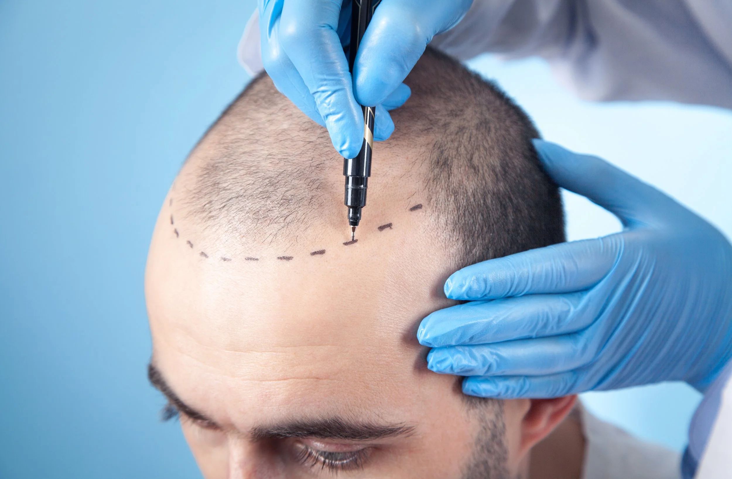 Hair transplant london