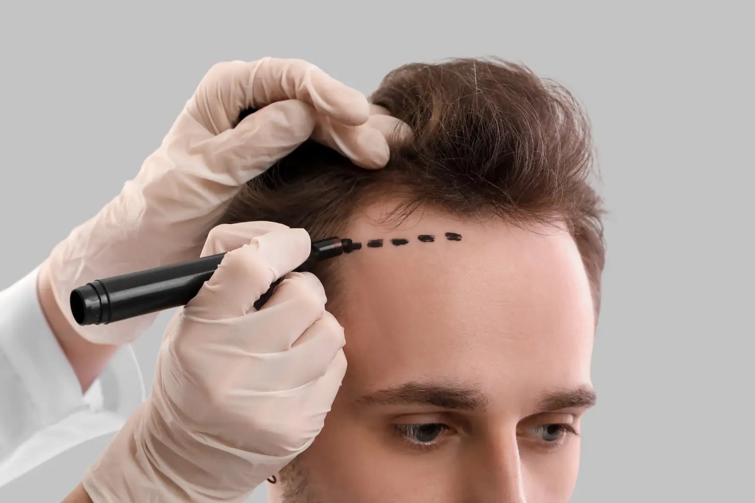 Hair transplant london