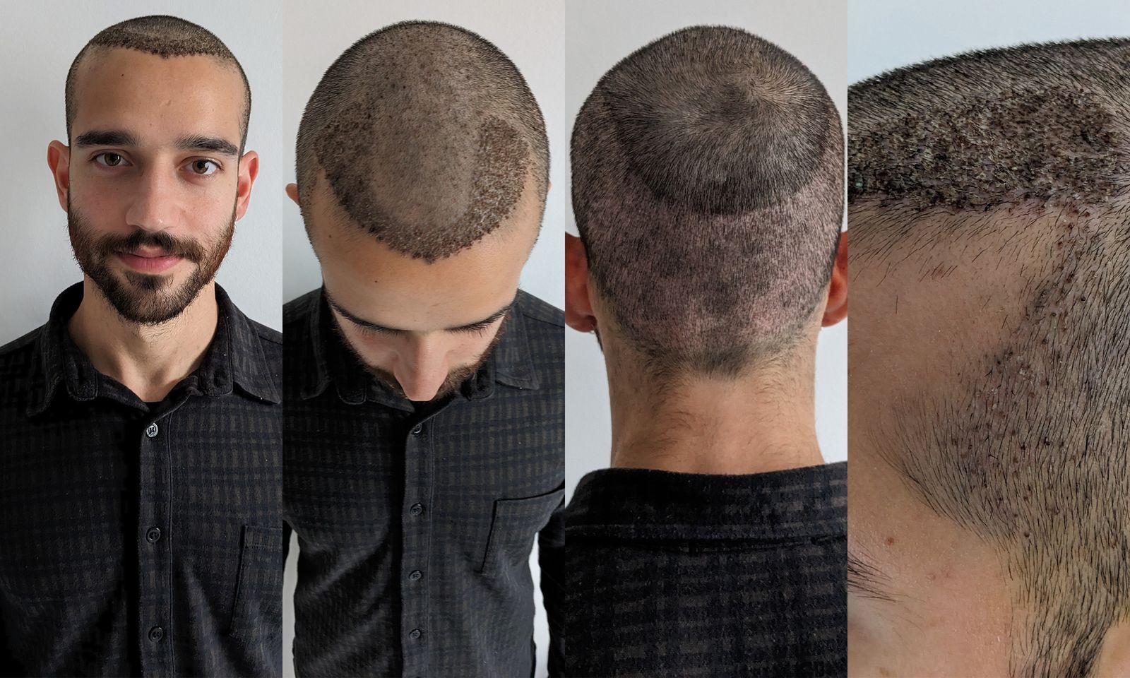Hair transplant uk