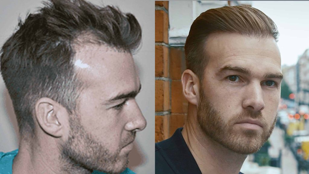 Hair transplant uk